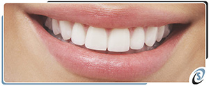 Porcelain Veneers Near Me in Toledo, OH Porcelain Veneers Near Me in Toledo, OH