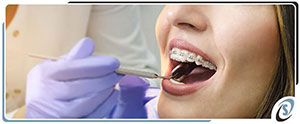 Cost of Braces Near Me in Toledo OH Cost of Braces Near Me in Toledo OH