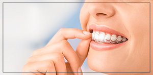 Invisalign Clear Braces Near Me in Toledo, OH