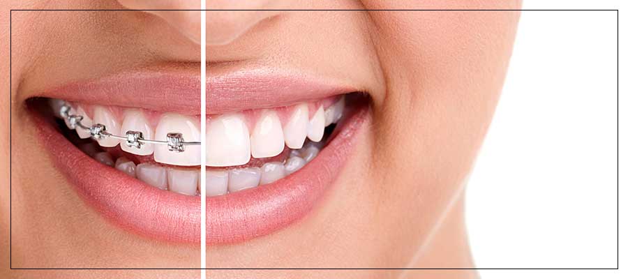 Dental Veneers vs. Braces Near Me in Toledo Ohio