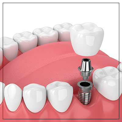 Dental Implants Near Me in Toledo, OH