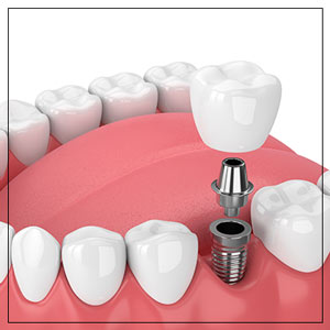 Dental Implants Near Me in Toledo, OH